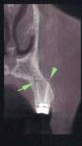 Ожог гипохлоритом натрия в стоматологии