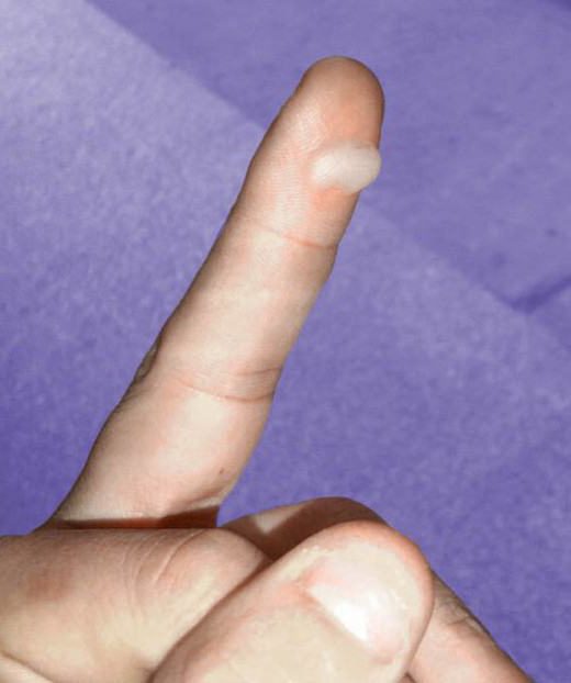 можно ли проколоть пузырь от ожога