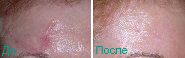 эффект после лазерной шлифовки рубцов