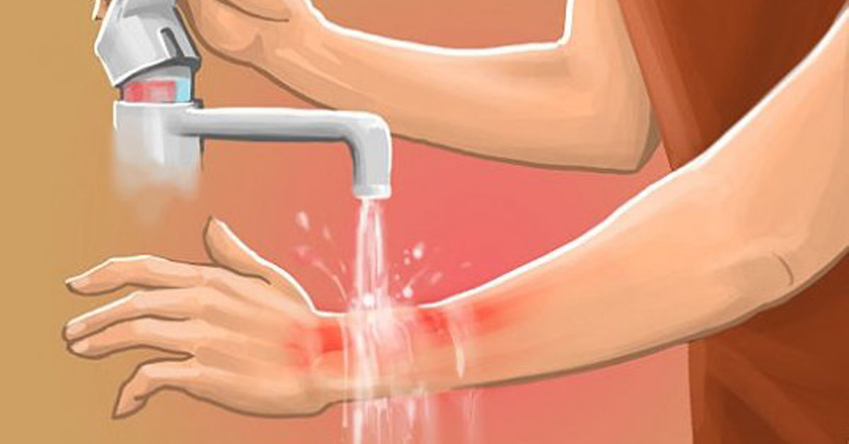 Ожог признаки и первая помощь