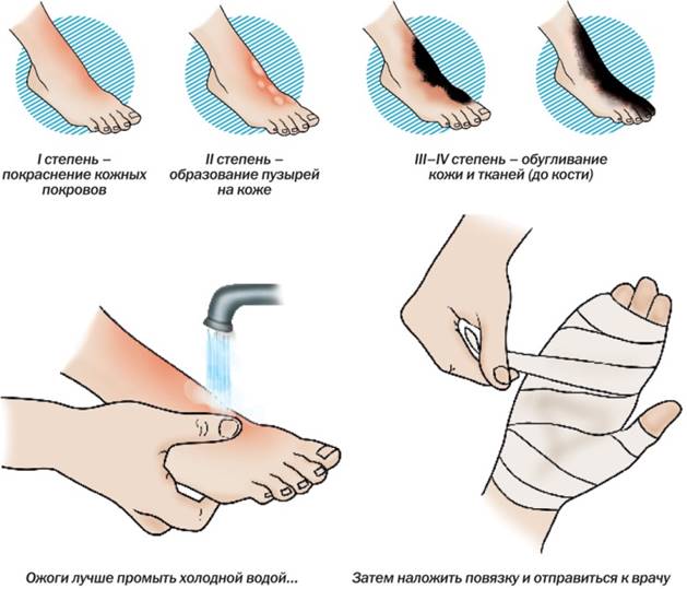 Ожог признаки и первая помощь