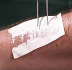 Ожог признаки и первая помощь