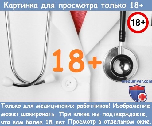 Течет гной из уха ребенка