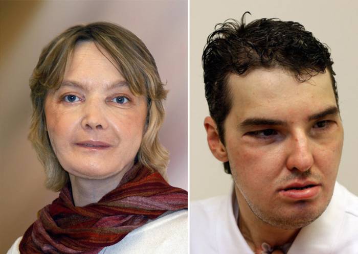 10 самых невероятных операций по пересадке лица в истории 10 самых невероятных операций по пересадке лица в истории