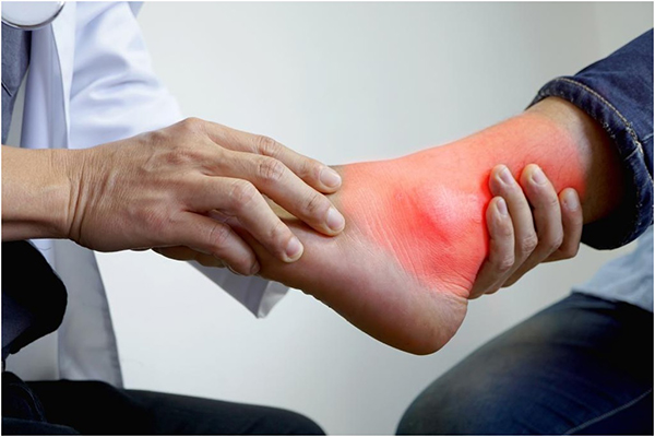 Развитие подагры