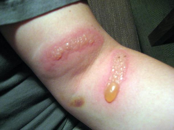 ожог от растения