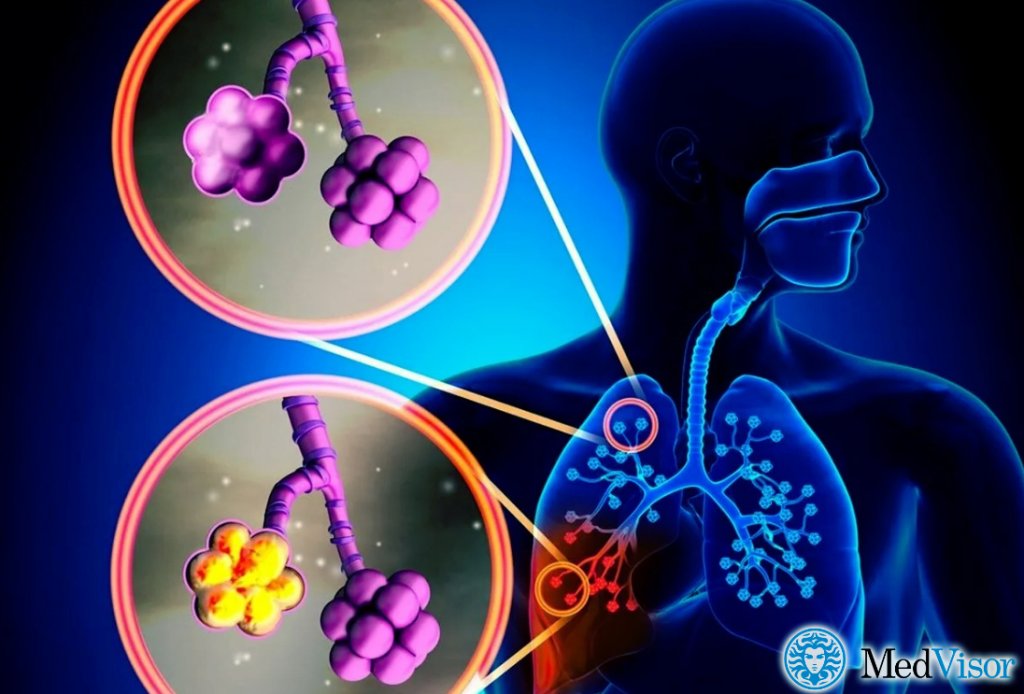 Пневмония без уточнения возбудителя Что хуже обструктивный бронхит или пневмония