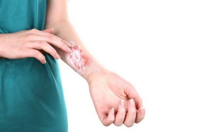 помощь при ожогах 2 степени