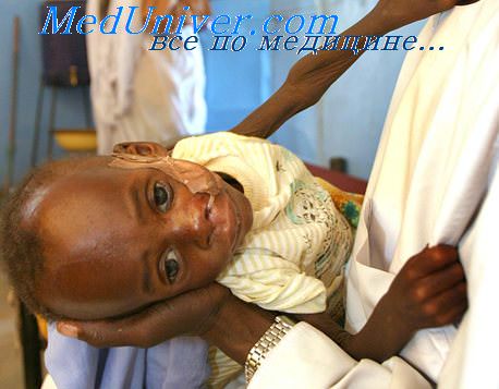 очаговый туберкулез