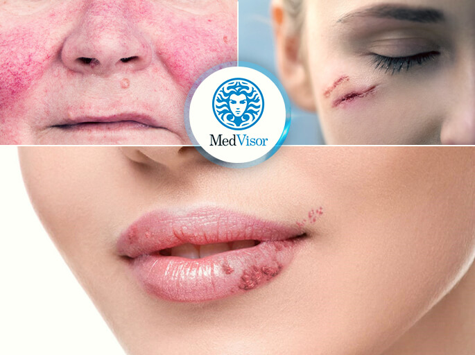 противопоказания для пилинга Как избавиться от ожога от салицилового спирта