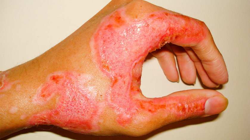 Ожог третьей степени - виды ожогов. Стерильно.com