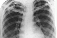 Очаговый туберкулез легких Очаговый туберкулез легких