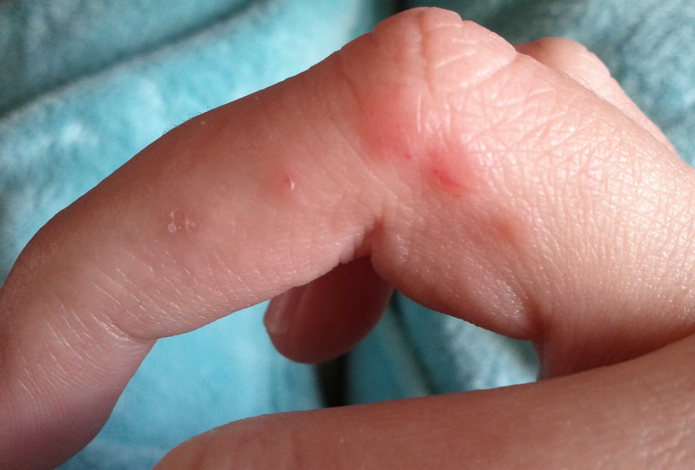 внутренняя этиология пузырьков на руках