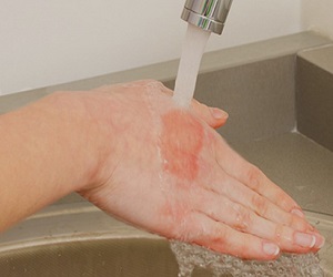 следы от ожога