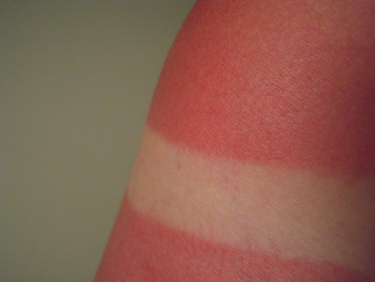 Лучшее средство при солнечных ожогах