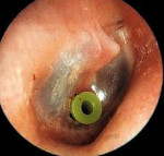 Что такое хронический экссудативный отит Что такое хронический экссудативный отит thumbnail