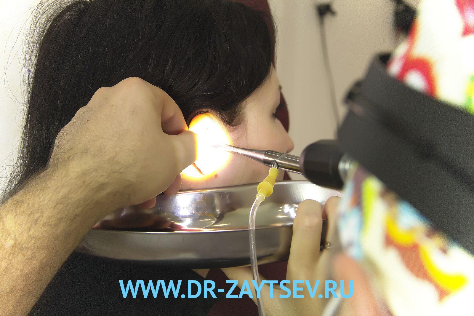 Чем и как лечить отит у взрослых лечение