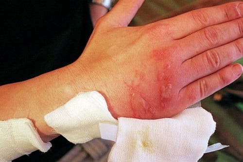 ожог эфирным маслом