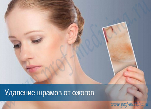 Шлифовка лазером рубцов после ожогов