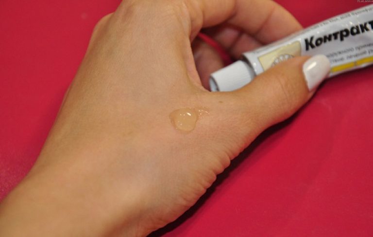 Шлифовка лазером рубцов после ожогов