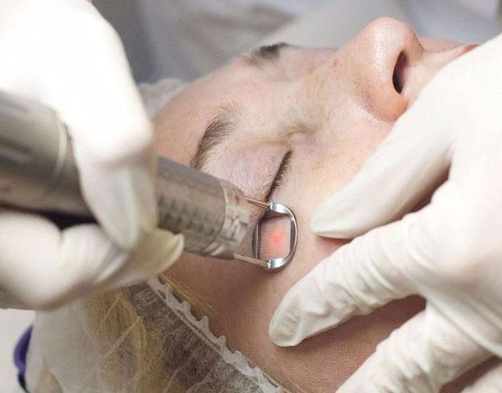 Шлифовка лазером рубцов после ожогов