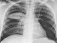 Хламидийная пневмония Хламидийная пневмония