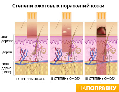 степени ожогов.jpg степени ожоговых поражений кожи.jpg