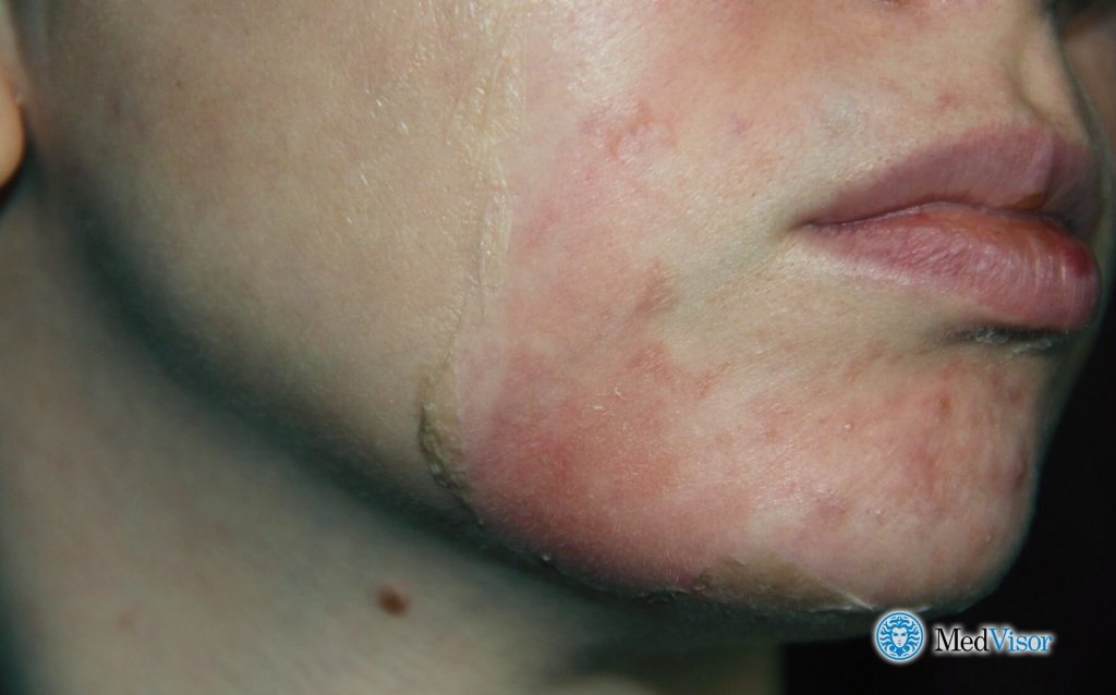 Ожог после салицилового пилинга Как избавиться от ожога от салицилового спирта