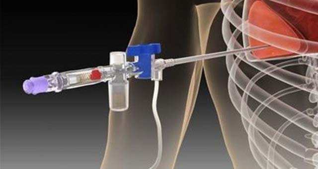 Плевральная пункция