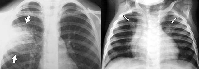 Рентген снимки легких