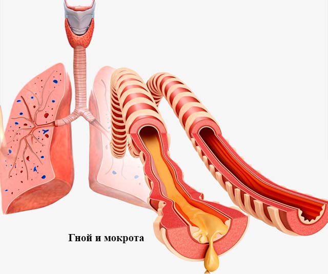 Гной и мокрота в легких