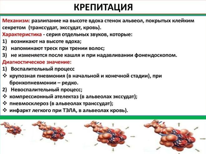 Крепитация