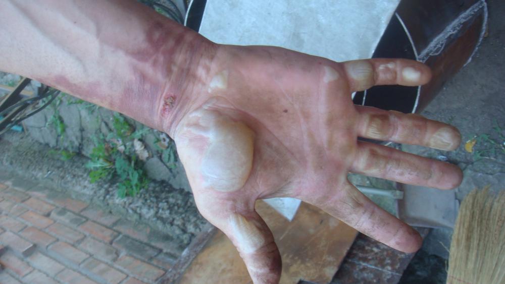 Волдыри при ожоге