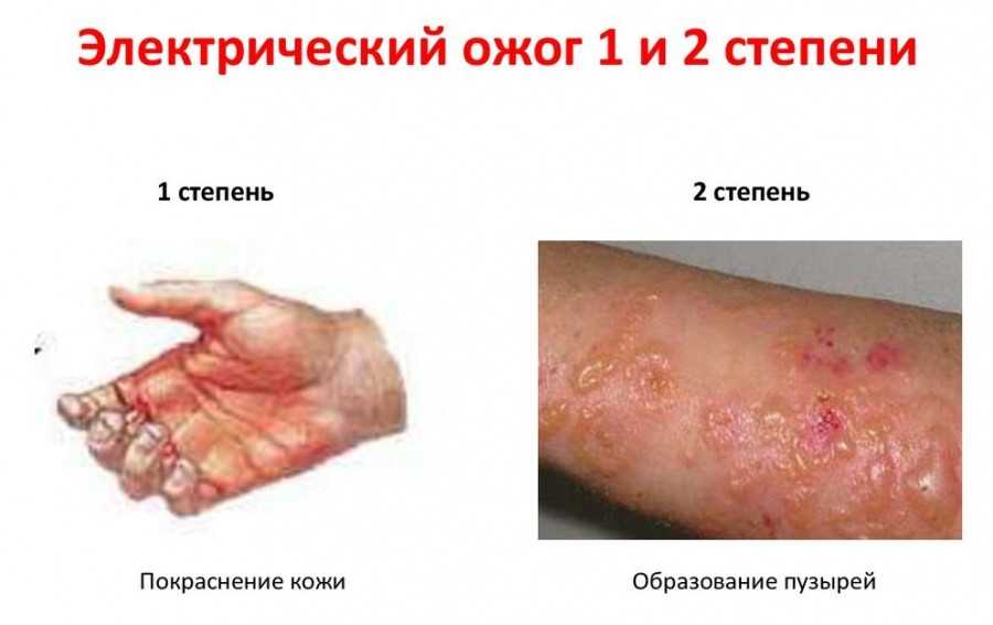 Ожоги электрическим током степени фото