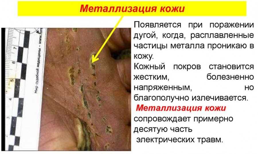 Ожоги электрическим током степени фото