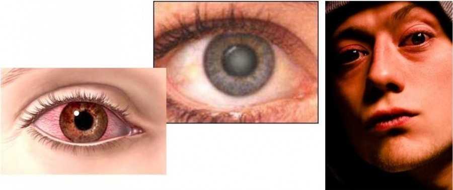 Ожоги электрическим током степени фото