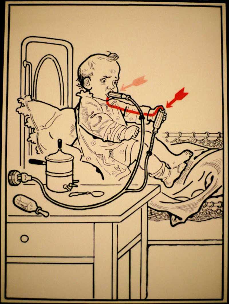 Ожоги электрическим током степени фото