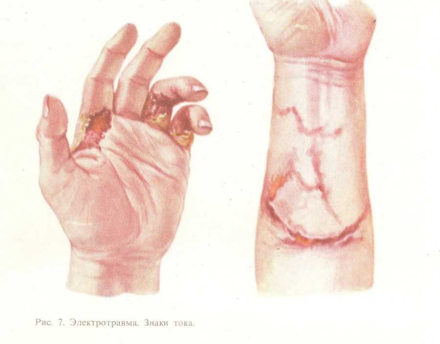 Ожоги электрическим током степени фото