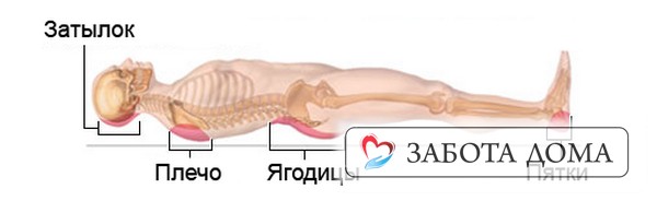 Если пациент лежит на спине - появляются пролежни на ягодицах, пятках, копчике, спине и затылке. Зоны пролежней