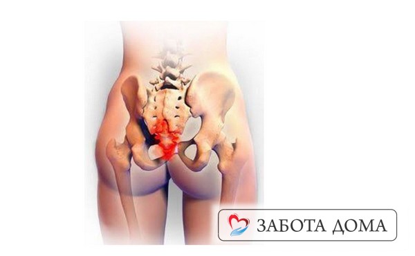 Пролежни на копчике чаще возникают у лежачих пациентов, но могут появиться и у колясочников при недостаточном уходе за ними. Пролежень на копчике