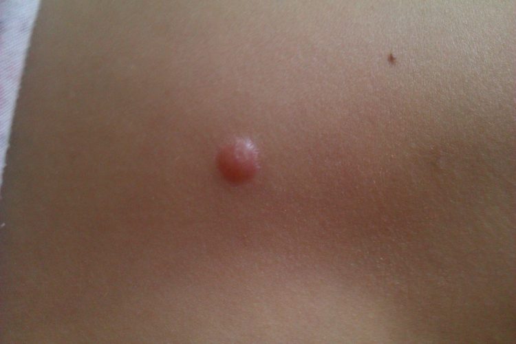 Волдыри на пальцах рук у ребенка похожие на ожог не чешется и не болит