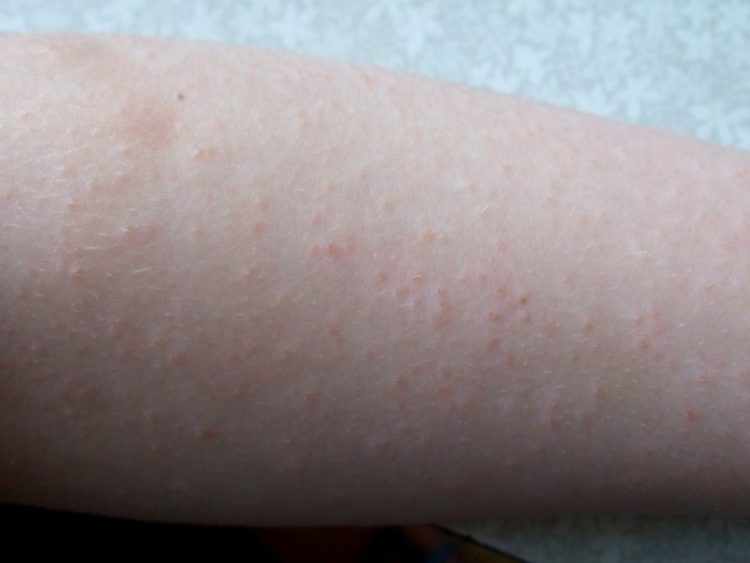 Волдыри на пальцах рук у ребенка похожие на ожог не чешется и не болит