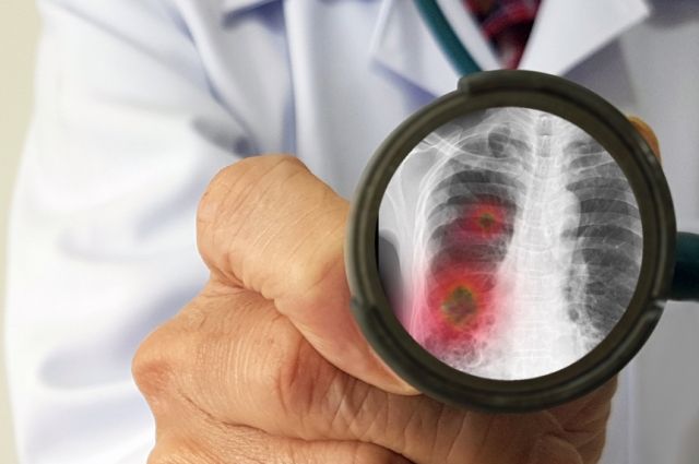 Режим физических нагрузок при пневмонии