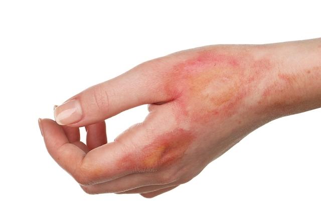 Небольшой ожог Небольшой ожог