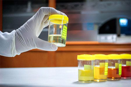 Анализ мочи Анализ мочи