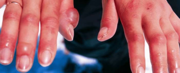 obzhegla-palets-kak-snjat-bol obzhegla-palets-kak-snjat-bol.png