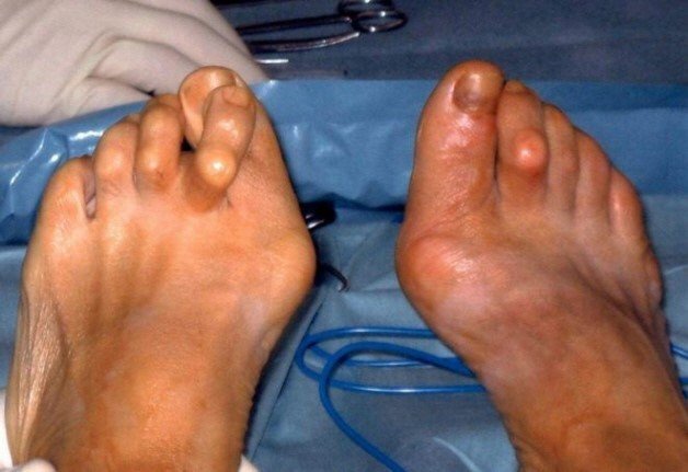Подагра ног Подагра ног