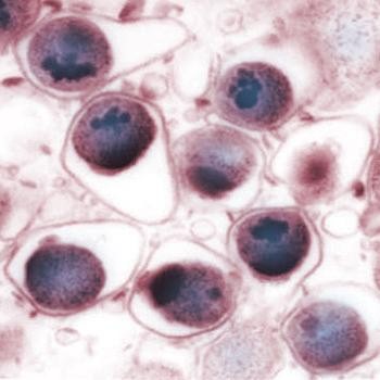 Хламидийная пневмония у детей