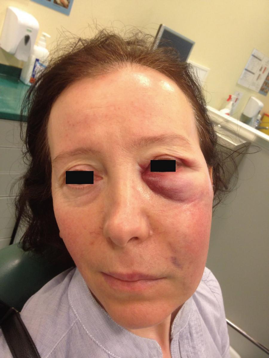 Ожог гипохлоритом натрия в стоматологии