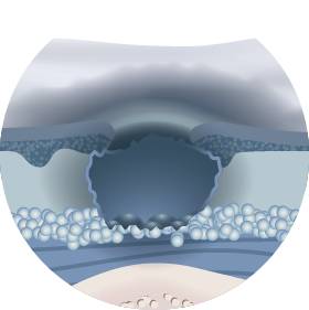 Современные повязки для лечения трофических язв нижних конечностей Современные повязки для лечения трофических язв нижних конечностей
